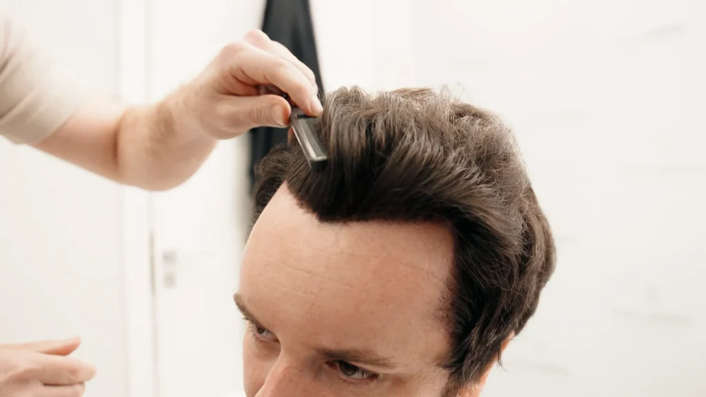 Doctor drawing patient’s hairline during hair transplant consultation