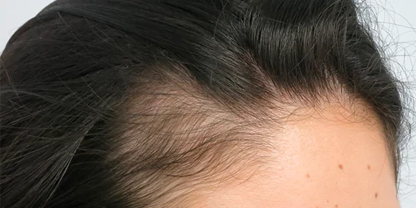 Receding hairline and thinning from telogen effluvium