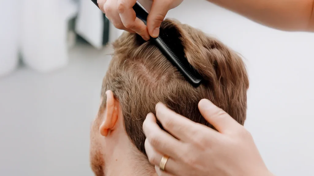 Hands combing through patient’s hair to examine donor area before transplant