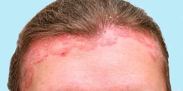 Redness and flaking on hairline from seborrheic dermatitis and psoriasis