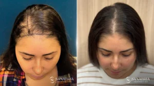 Before-and-after hair restoration results for female patient with thinning hair