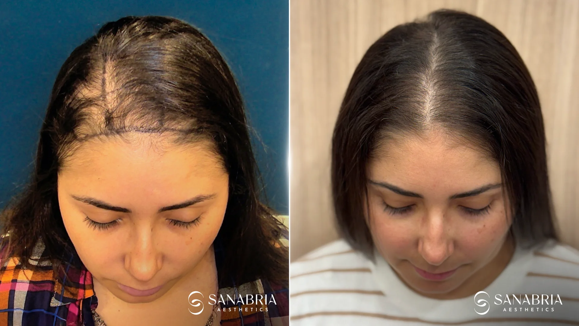 Before-and-after hair restoration results for female patient with thinning hair