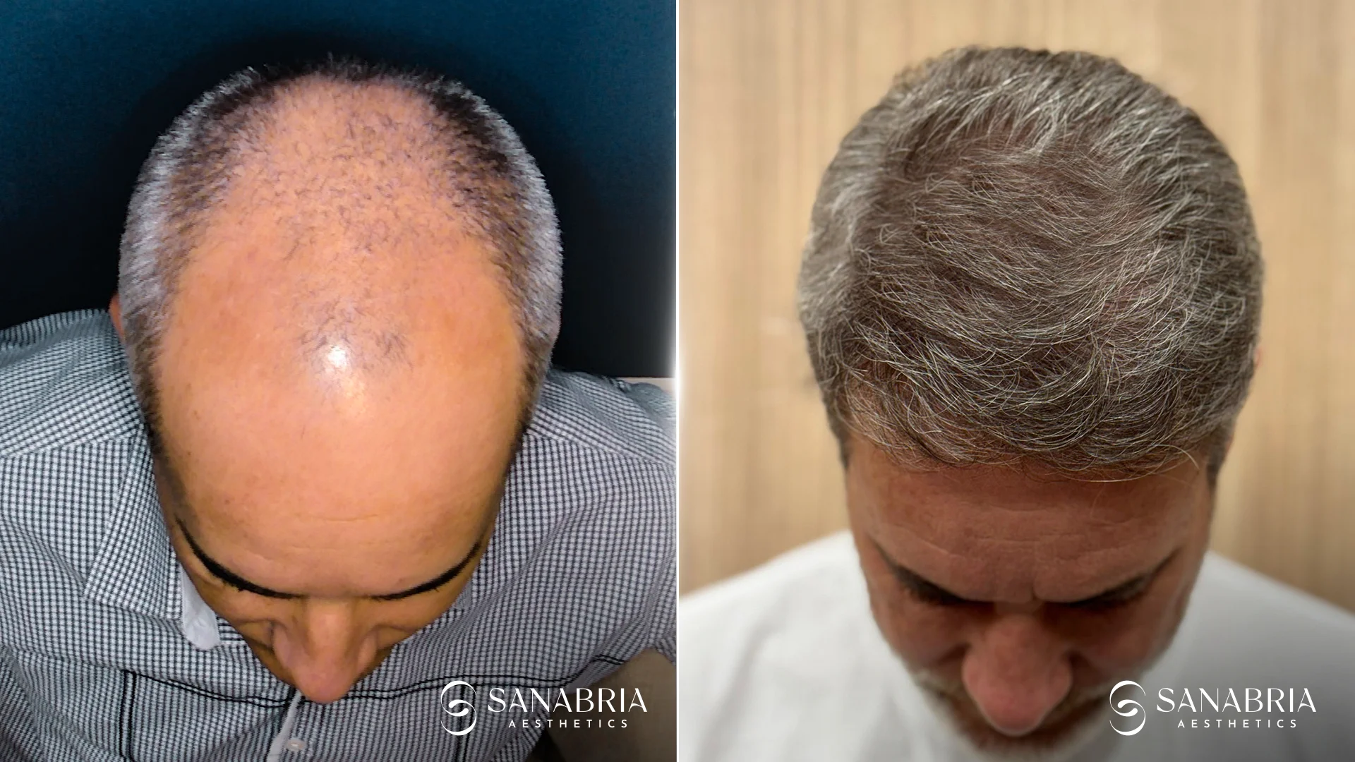 Before-and-after hair transplant results for male patient with advanced hair loss