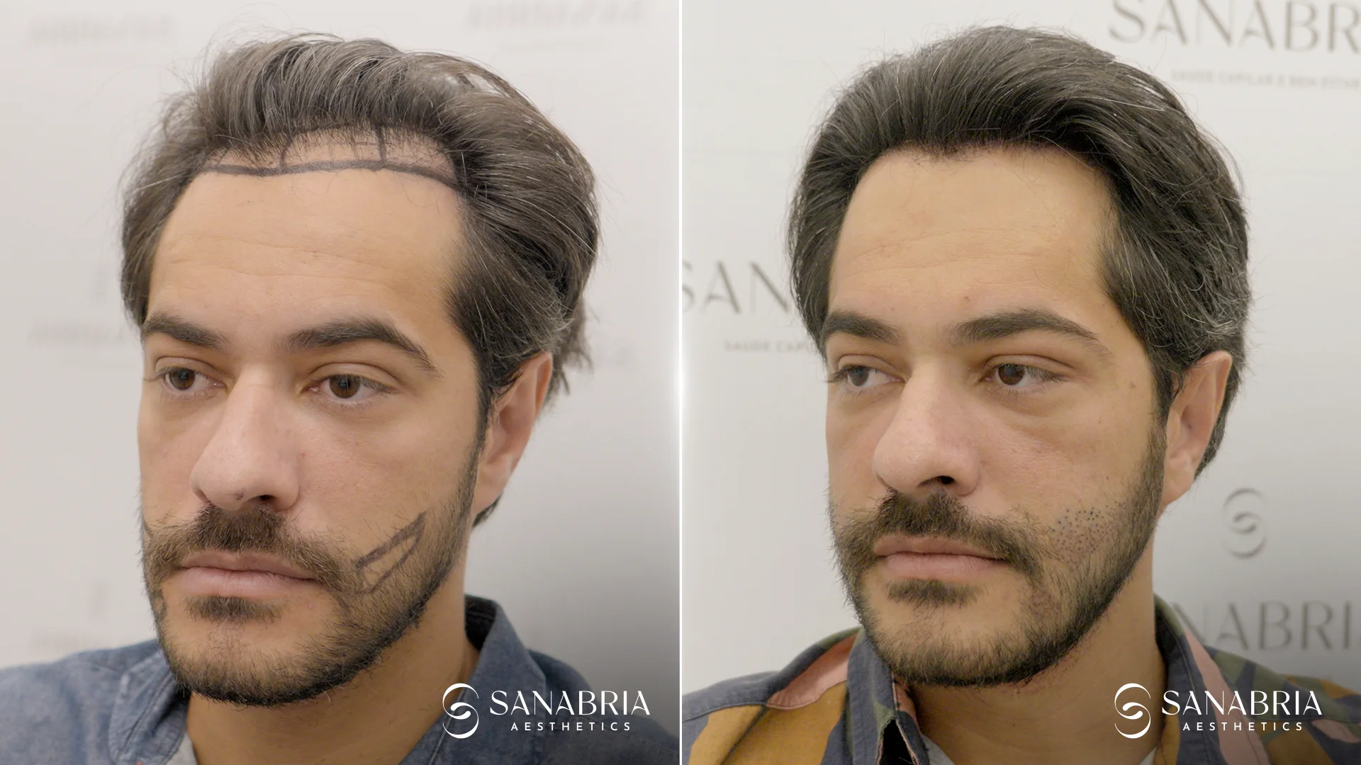 Before-and-after no-shave FUE results restoring male hairline and density