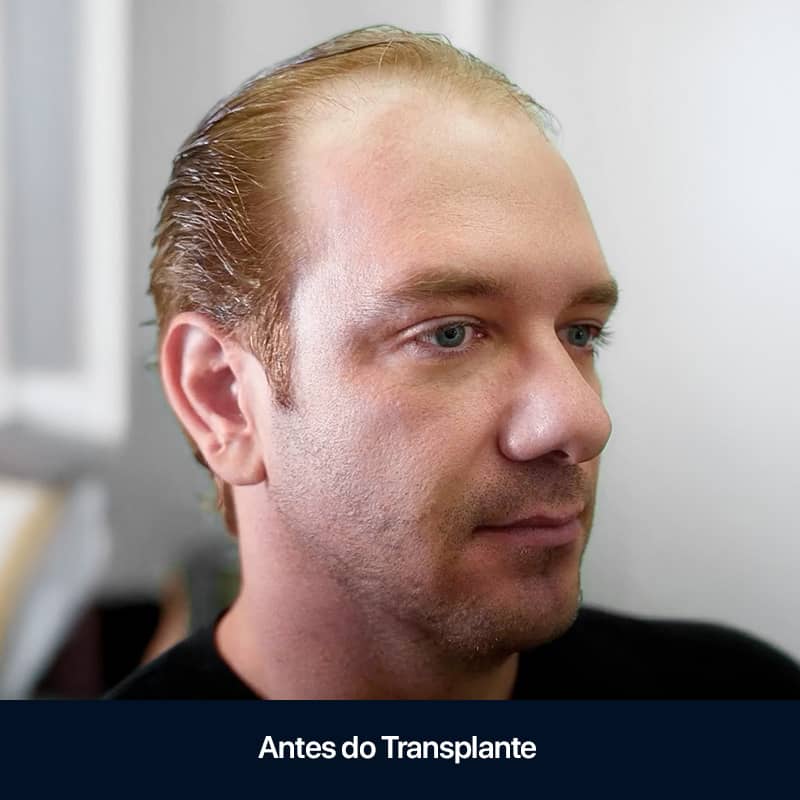 (04a) FUE Sem Raspagem_Site Oficial_Clinica Sanabria (04a) FUE Sem Raspagem_Site Oficial_Clinica Sanabria