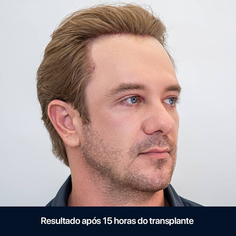 (04b) FUE Sem Raspagem_Site Oficial_Clinica Sanabria (04b) FUE Sem Raspagem_Site Oficial_Clinica Sanabria